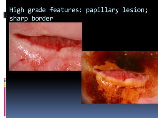 High grade features: papillary lesion;
sharp border
 