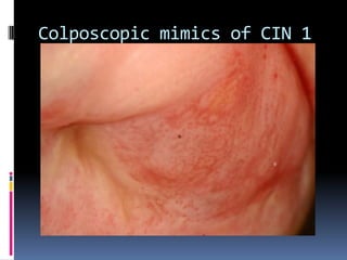 Colposcopic mimics of CIN 1
 