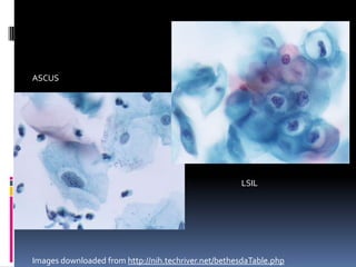 ASCUS
LSIL
Images downloaded from http://nih.techriver.net/bethesdaTable.php
 