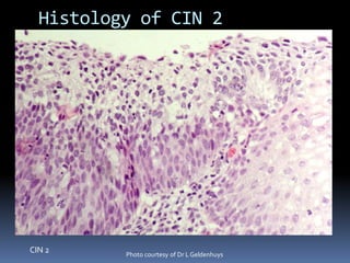 CIN 2 Photo courtesy of Dr LGeldenhuys
Histology of CIN 2
 