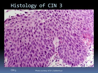 CIN 3 Photo courtesy of Dr LGeldenhuys
Histology of CIN 3
 