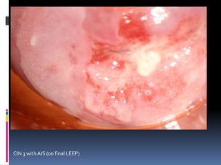 CIN 3 with AIS (on final LEEP)
 