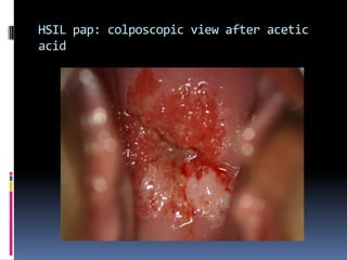 HSIL pap: colposcopic view after acetic
acid
 