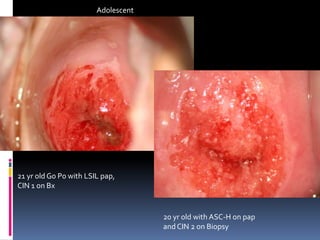 21 yr old G0 P0 with LSIL pap,
CIN 1 on Bx
20 yr old with ASC-H on pap
andCIN 2 on Biopsy
Adolescent
 