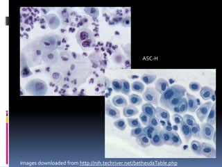 ASC-H
Images downloaded from http://nih.techriver.net/bethesdaTable.php
 