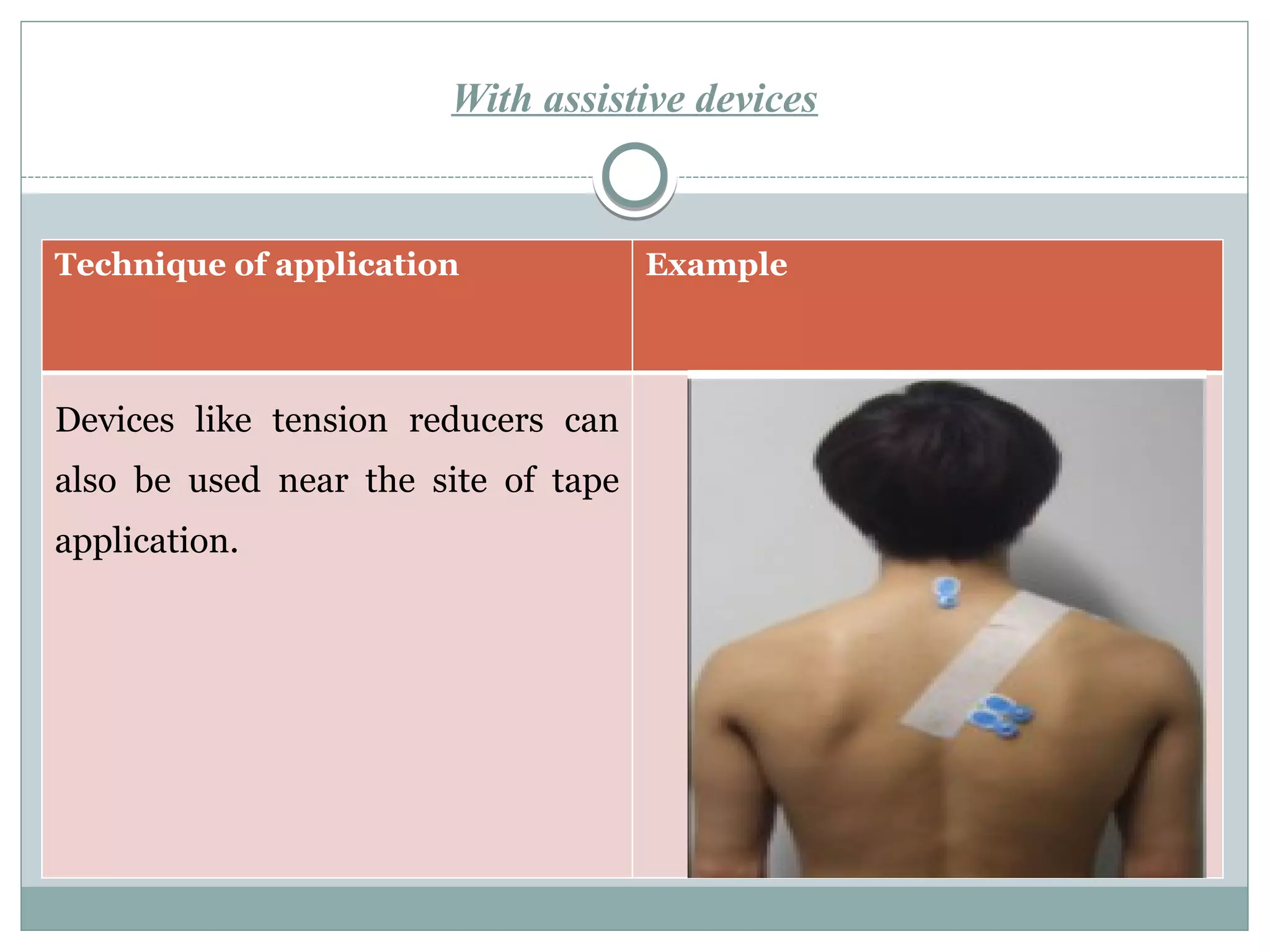 With assistive devices
Technique of application Example
Devices like tension reducers can
also be used near the site of tape
application.
 