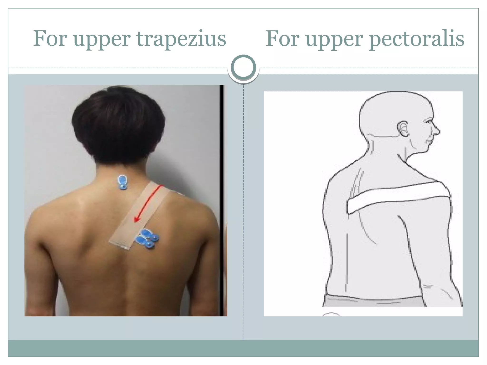For upper trapezius For upper pectoralis
 