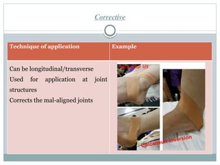 Corrective
Technique of application Example
Can be longitudinal/transverse
Used for application at joint
structures
Corrects the mal-aligned joints
 