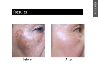 After
Before
Results
 