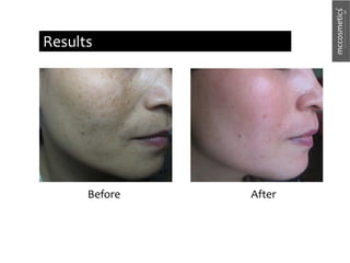 After
Before
Results
 