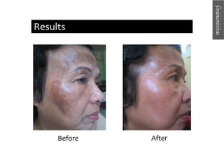 After
Before
Results
 