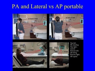 PA and Lateral vs AP portable 