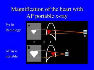 Magnification of the heart with AP portable x-ray PA in Radiology AP as a portable 