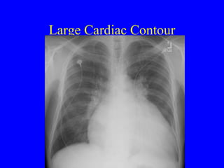 Large Cardiac Contour 