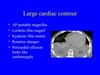 Large cardiac contour AP portable magnifies Lordotic film magnif Kyphotic film minim Rotation changes Pericardial effusion looks like cardiomegaly 