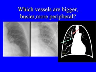 Which vessels are bigger, busier,more peripheral? 