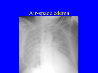 Air-space edema 