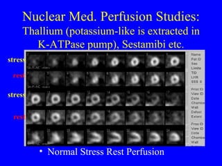 Nuclear Med. Perfusion Studies:  Thallium (potassium-like is extracted in K-ATPase pump), Sestamibi etc. Normal Stress Rest Perfusion stress rest stress rest 