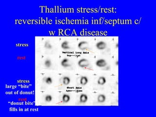 Thallium stress/rest: reversible ischemia inf/septum c/w RCA disease stress rest stress rest large “bite” out of donut! “ donut bite” fills in at rest 