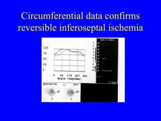 Circumferential data confirms reversible inferoseptal ischemia 