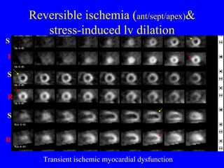 Reversible ischemia ( ant/sept/apex) & stress-induced lv dilation Transient ischemic myocardial dysfunction S R R S R S 