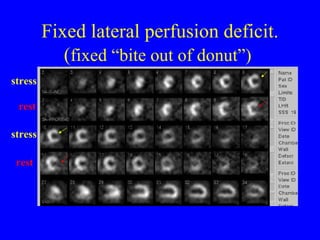 Fixed lateral perfusion deficit. ( fixed “bite out of donut”)   stress rest stress rest 