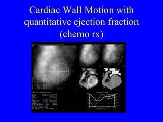 Cardiac Wall Motion with quantitative ejection fraction (chemo rx) 