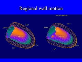 Regional wall motion 
