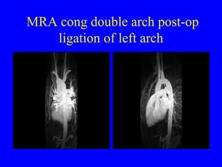 MRA cong double arch post-op ligation of left arch 