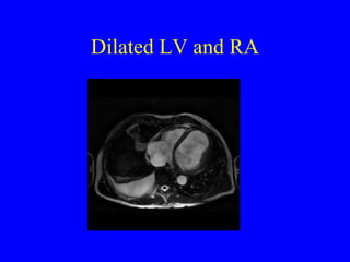 Dilated LV and RA 