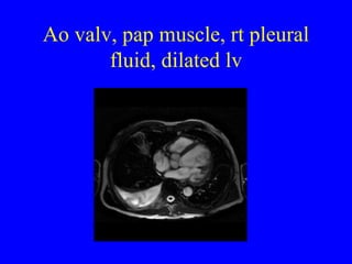 Ao valv, pap muscle, rt pleural fluid, dilated lv 
