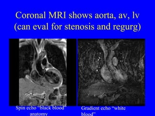 Coronal MRI shows aorta, av, lv (can eval for stenosis and regurg) Spin echo “black blood” anatomy Gradient echo “white blood” function & flow 
