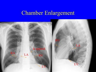 Chamber Enlargement LA LV RV RA LV RV la append LA 