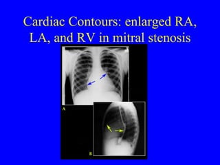 Cardiac Contours: enlarged RA, LA, and RV in mitral stenosis 