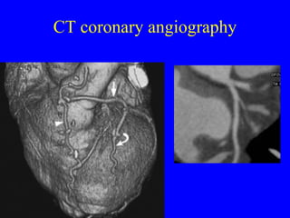 CT coronary angiography 