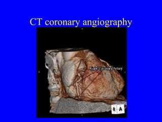 CT coronary angiography 