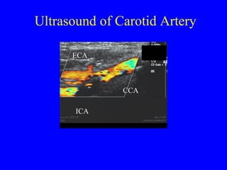 Ultrasound of Carotid Artery CCA ICA ECA 