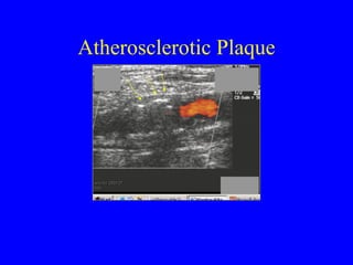 Atherosclerotic Plaque 