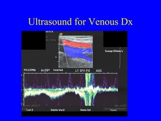 Ultrasound for Venous Dx 