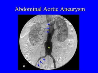 Abdominal Aortic Aneurysm 