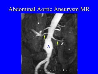 Abdominal Aortic Aneurysm MR 