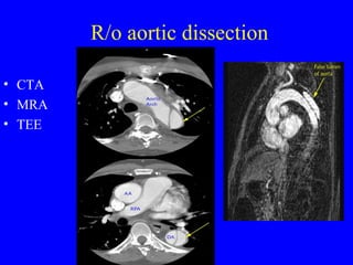 R/o aortic dissection CTA MRA TEE 