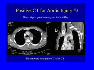 Aortic Trauma 