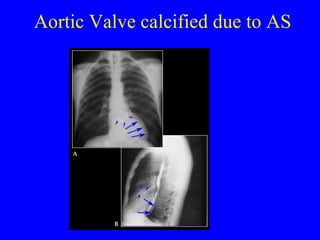 Aortic Valve calcified due to AS 