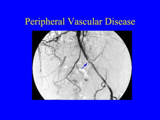 Peripheral Vascular Disease 