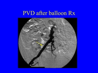 PVD after balloon Rx 