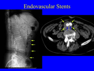 Endovascular Stents 