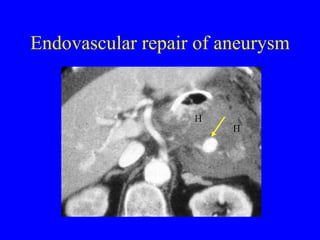 Endovascular repair of aneurysm 