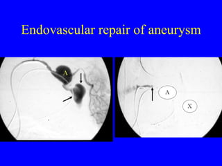 Endovascular repair of aneurysm 
