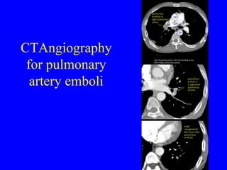 CTAngiography for pulmonary artery emboli 